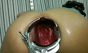 speculum prolapse ne ...